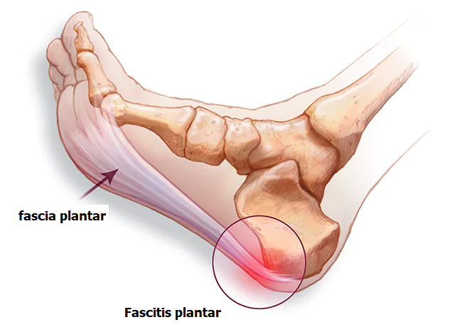 Fascitis plantar